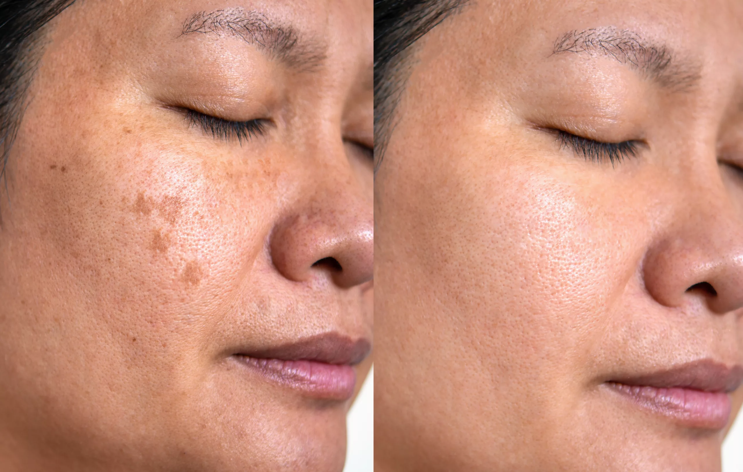 Las Vegas melasma Treatment - RAREV melasma treatment