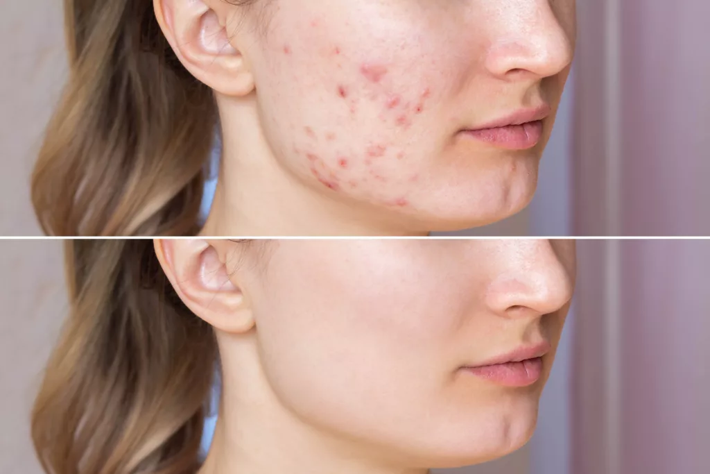 what-makes-someone-prone-to-developing-acne-scars-rarev