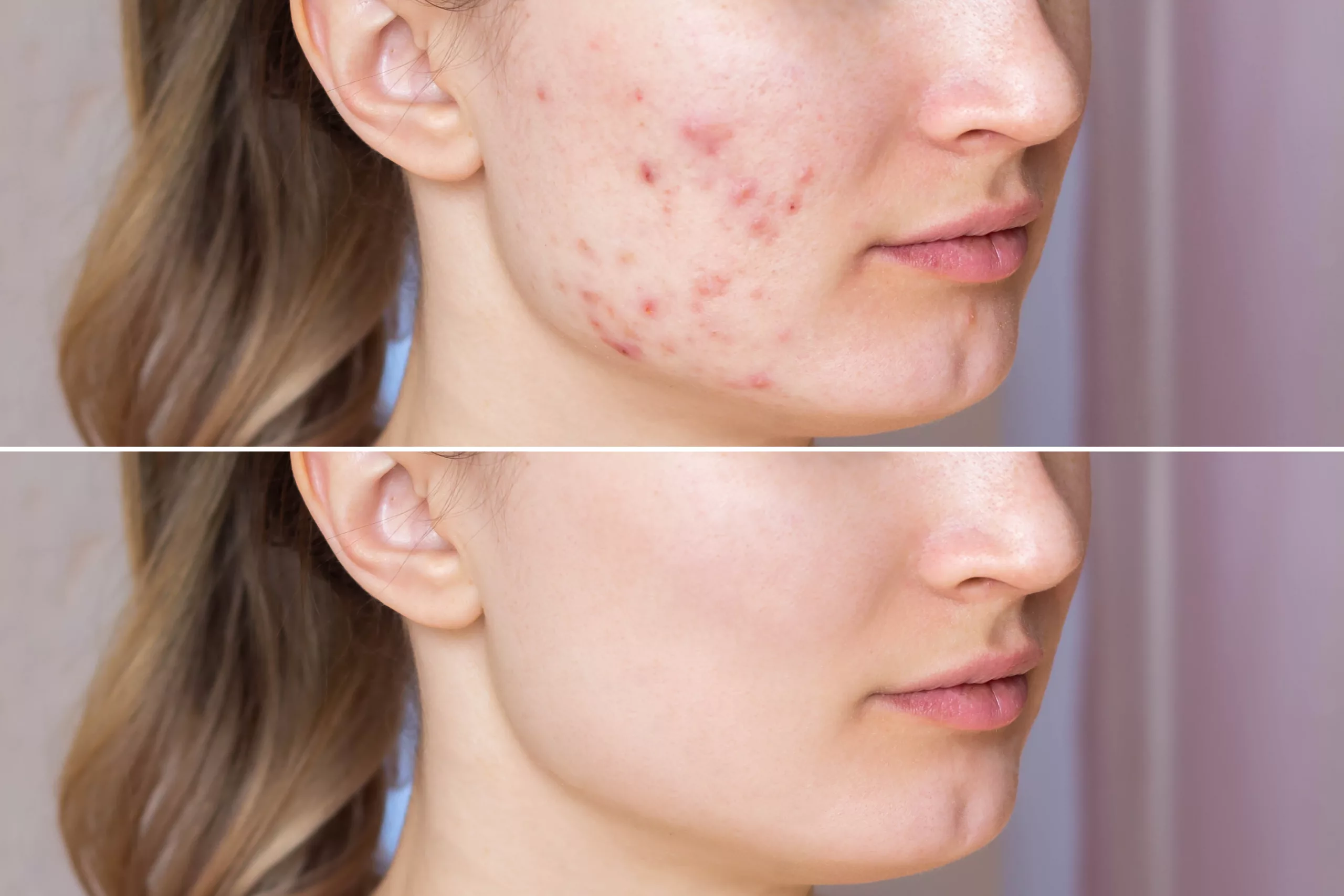 acne before after