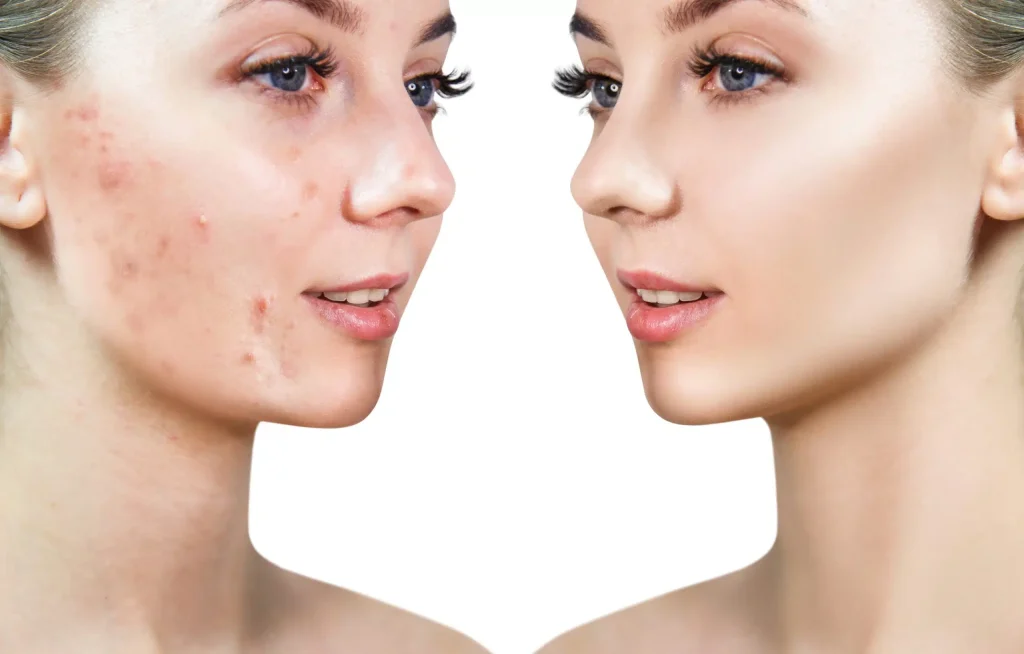 acne treatment before and after at rareV medspa Las Vegas