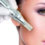 bruising after microneedling? Showing woman getting a micro needling treatment