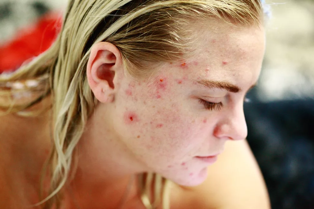 How Acne Works and How We Can Treat It