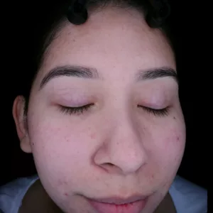 acne after treatment at RAREV Medspa