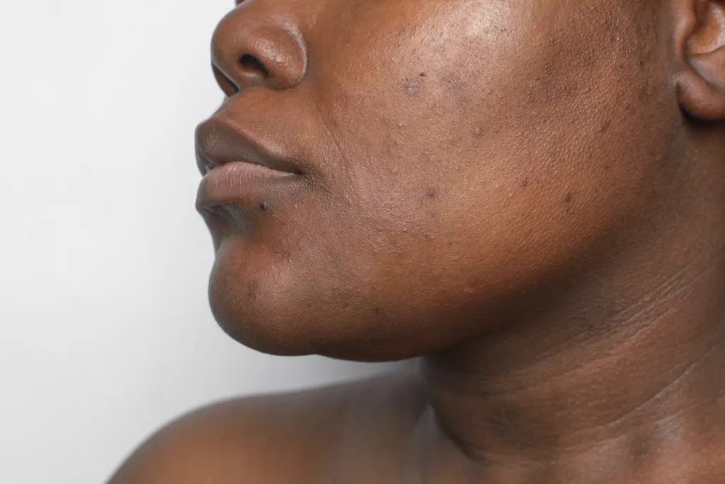 Does Microneedling Help Melasma?