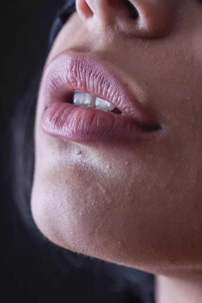 Best Lip Fillers in Las Vegas