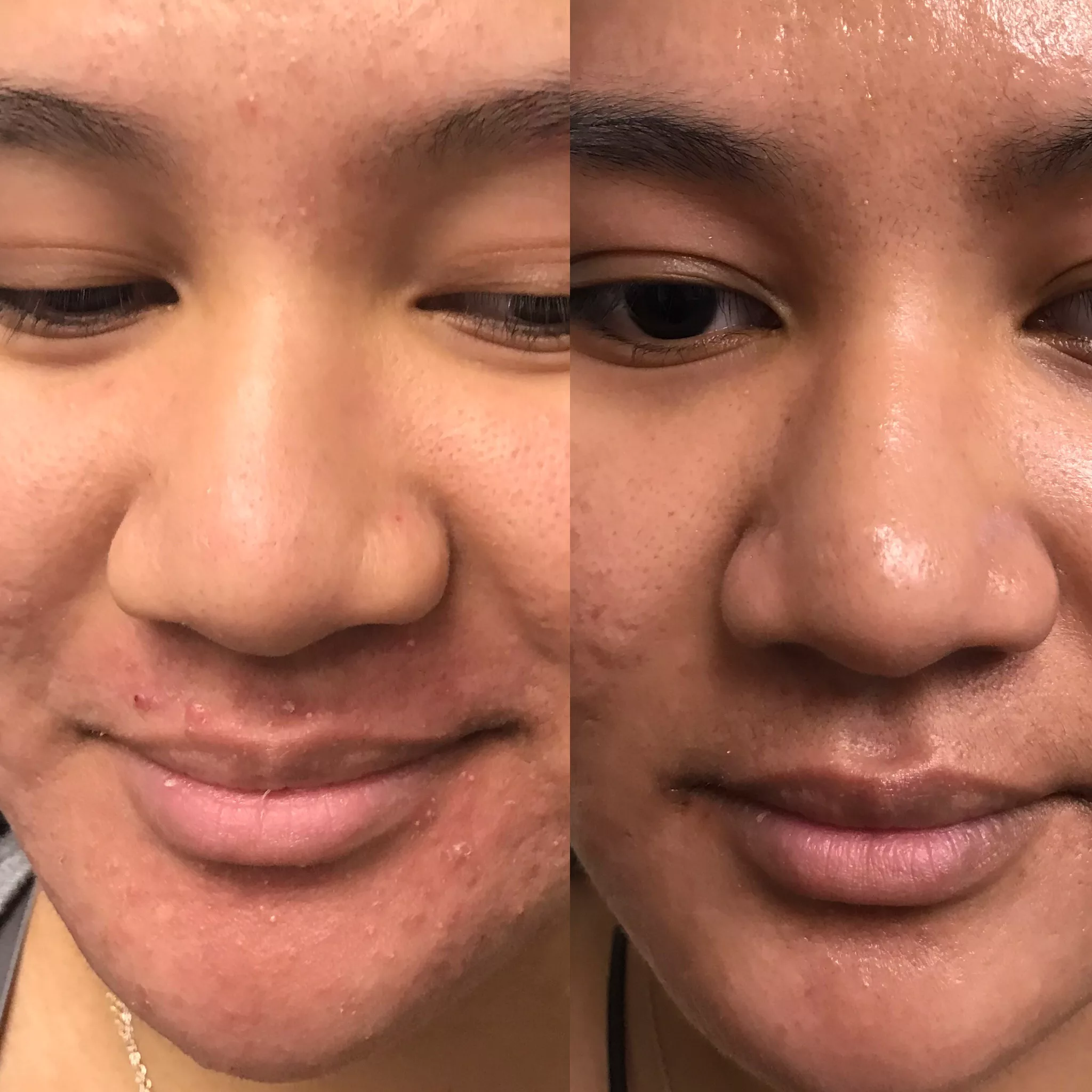 Las Vegas Acne Scar Treatment