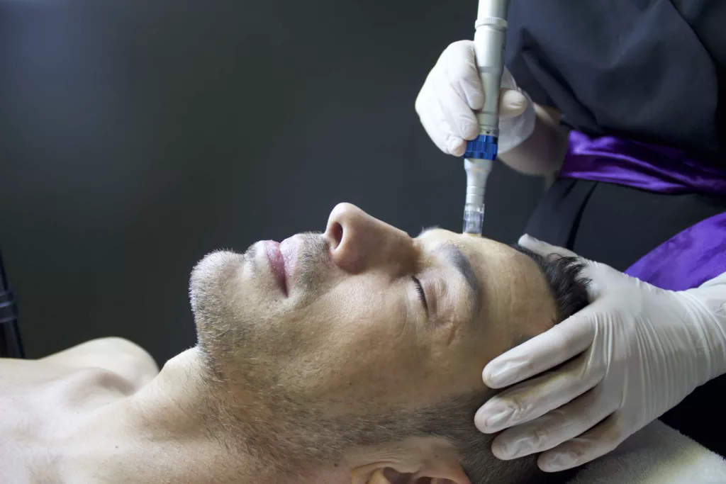 Microneedling for Men