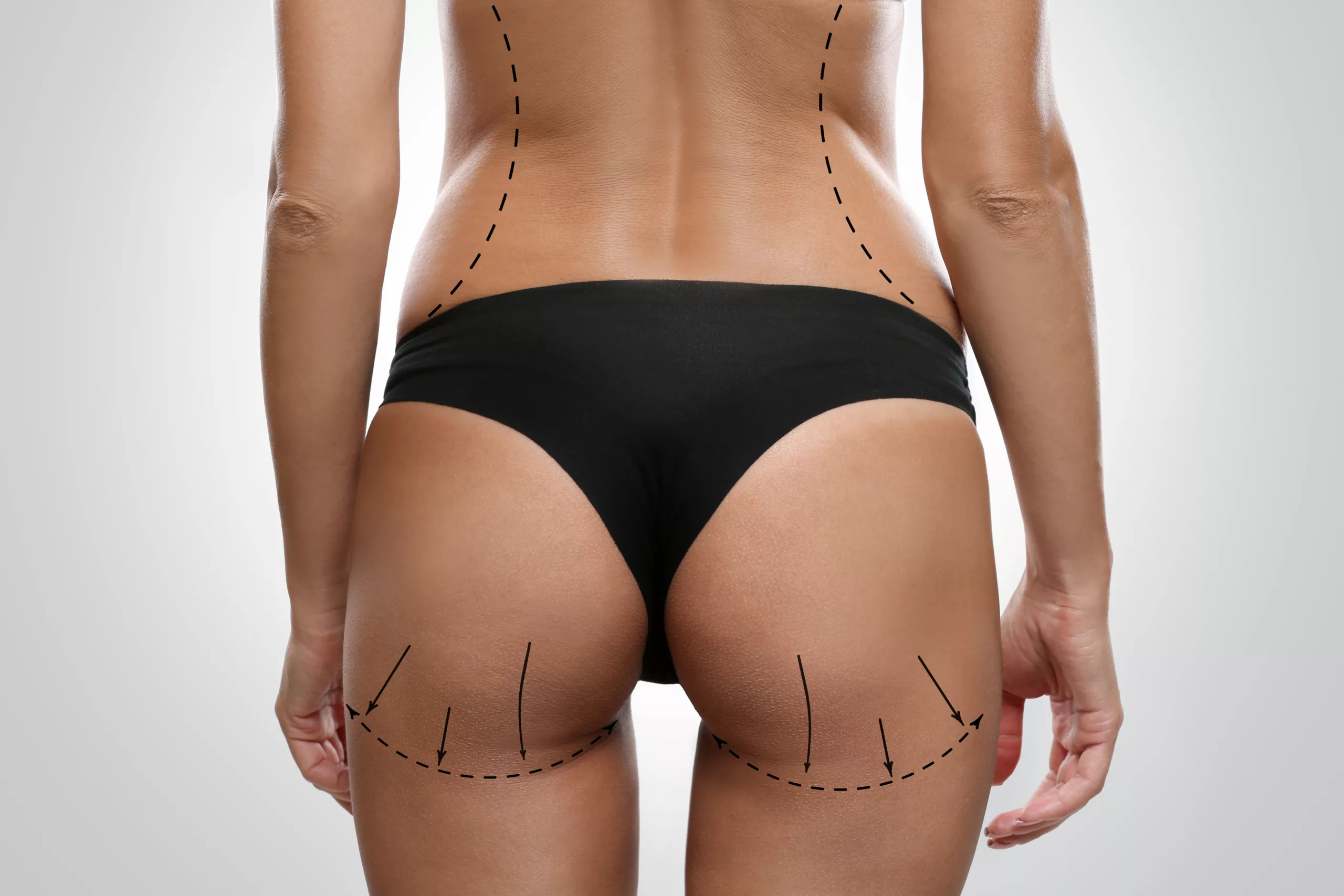 Non Surgical Butt Lift