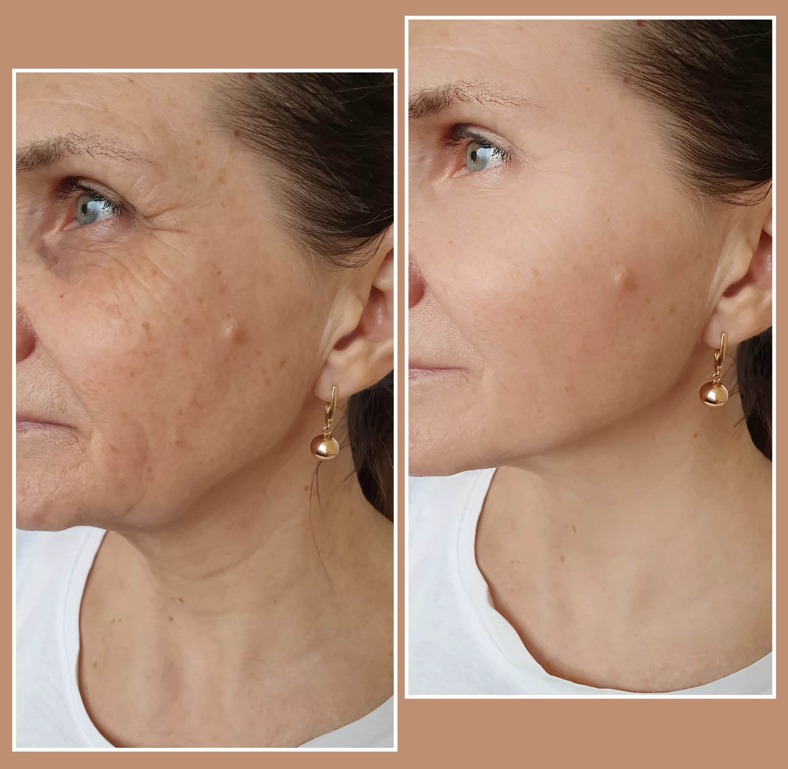 woman face wrinkles before and after treatment