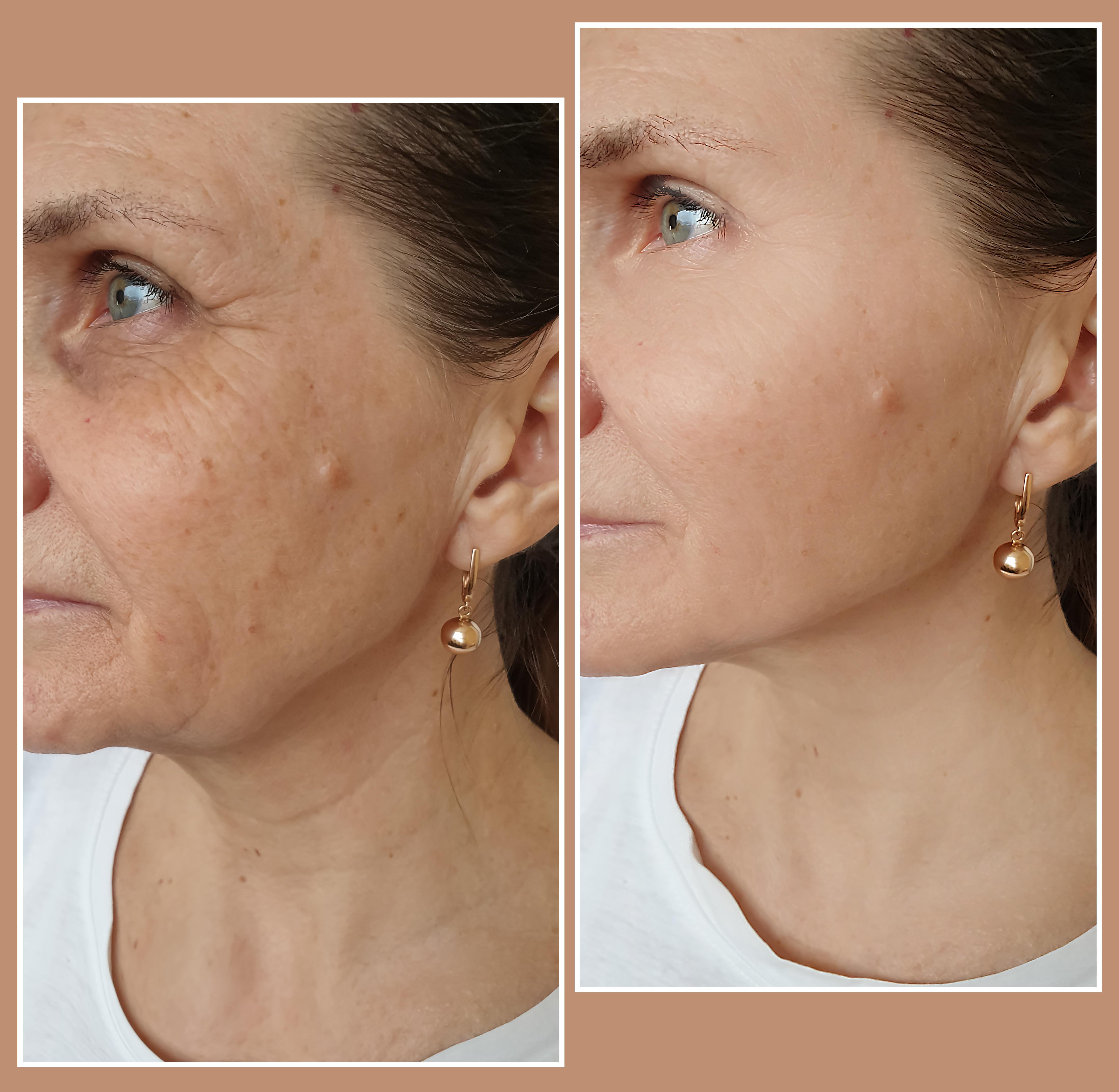 How Long Will Nonsurgical Skin Tightening Results Last?