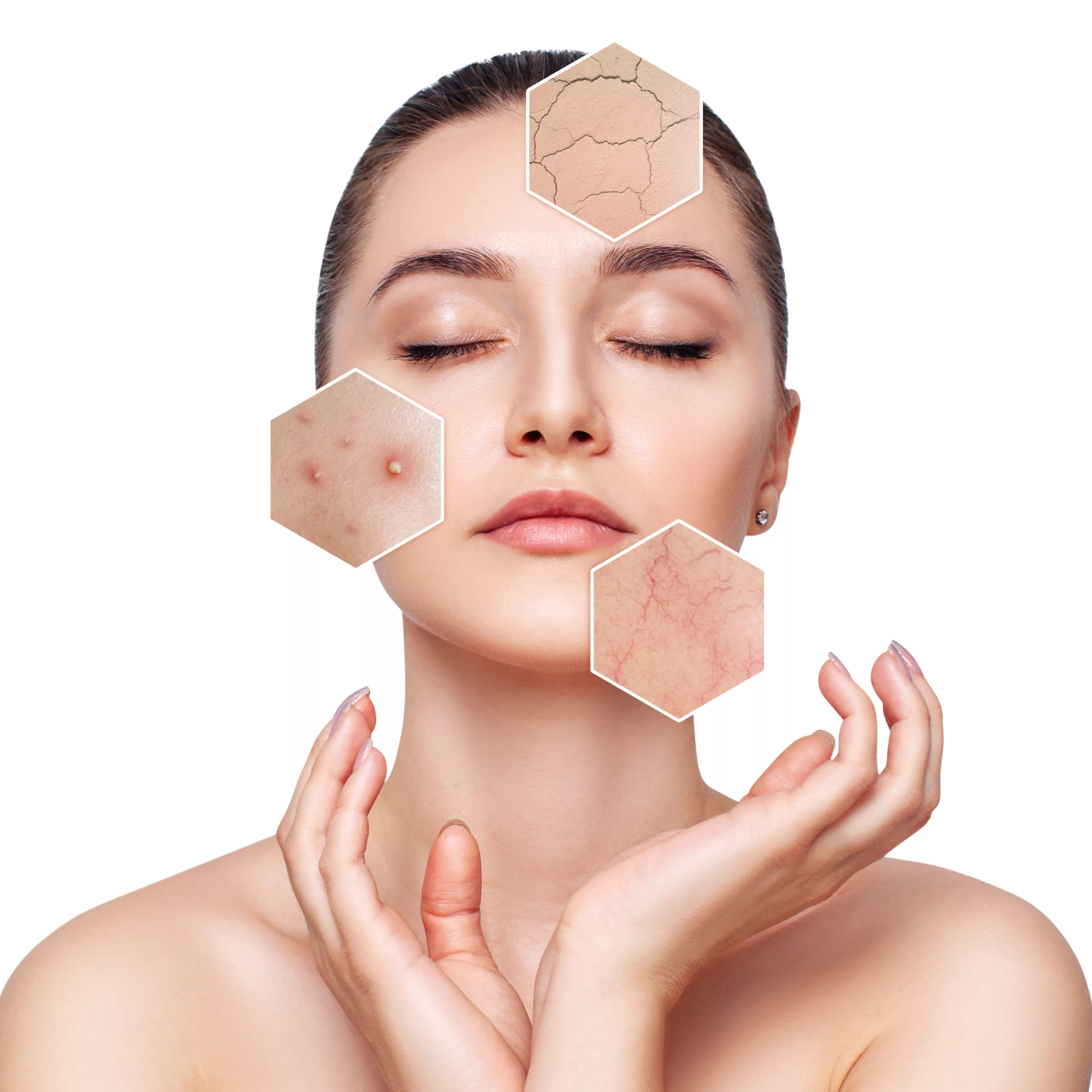 Should Skin Be Breakout-Free Before Acne Scar Treatment