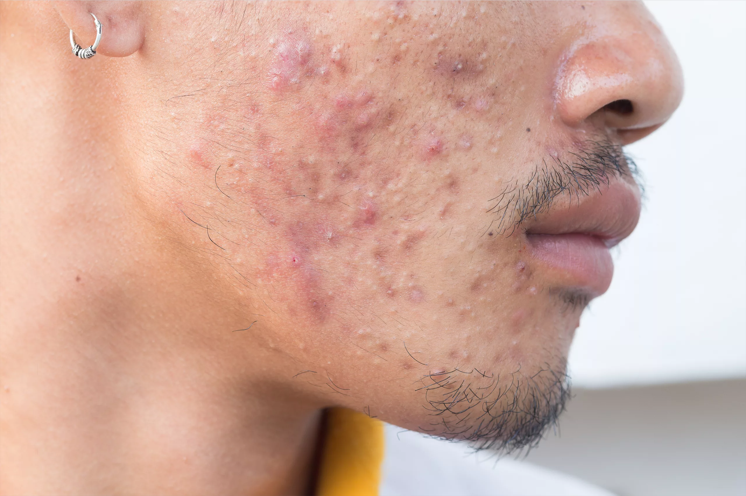 Will Acne Scars Go Away on Their Own