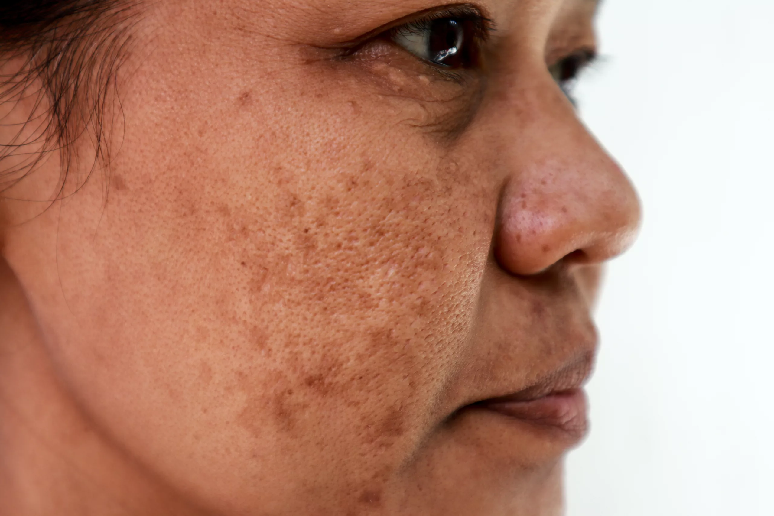 Melasma Causes and Treatments in Las Vegas 