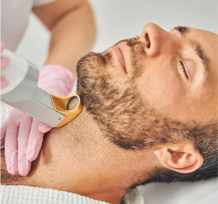 laser hair removal for men