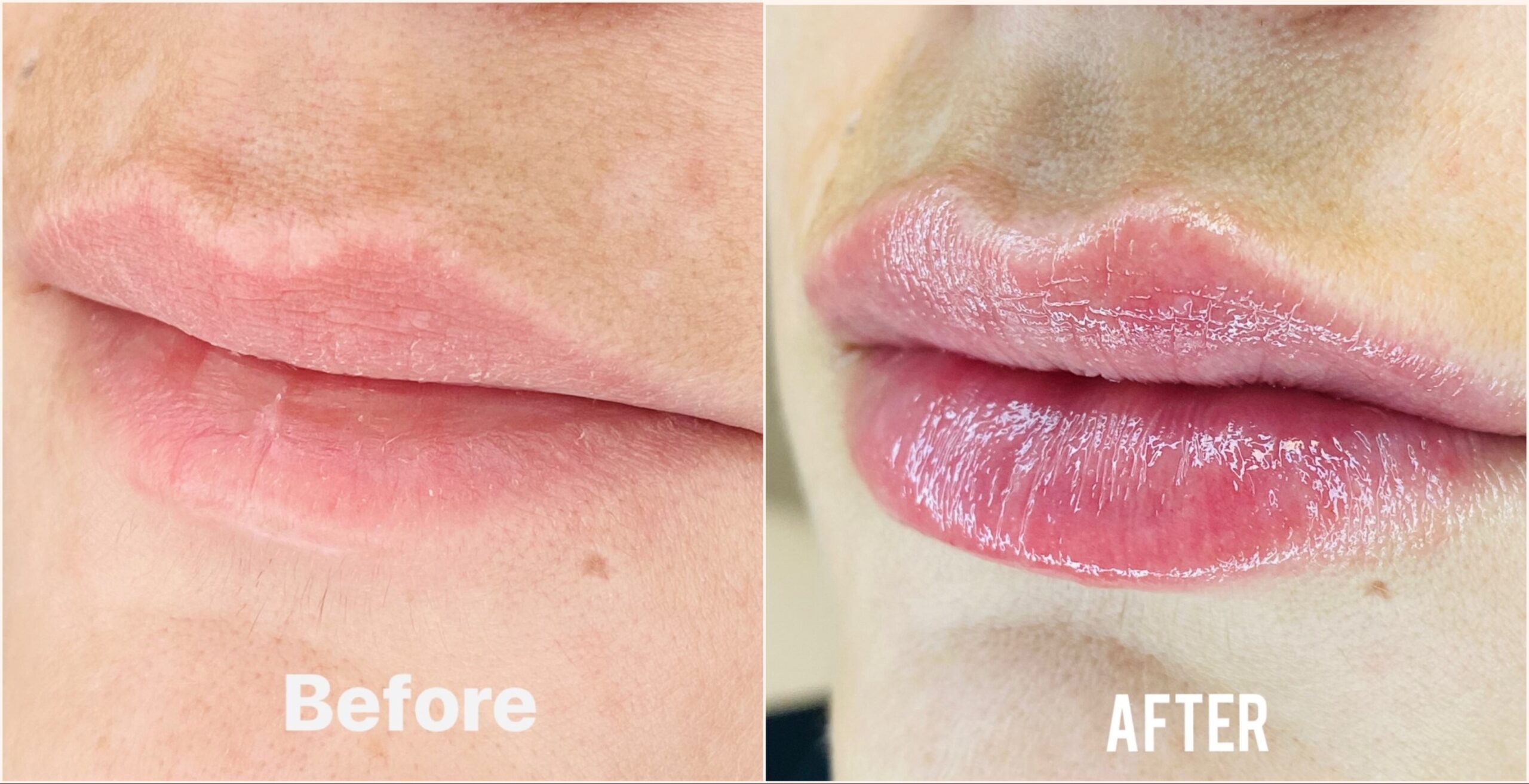 lip filler before after