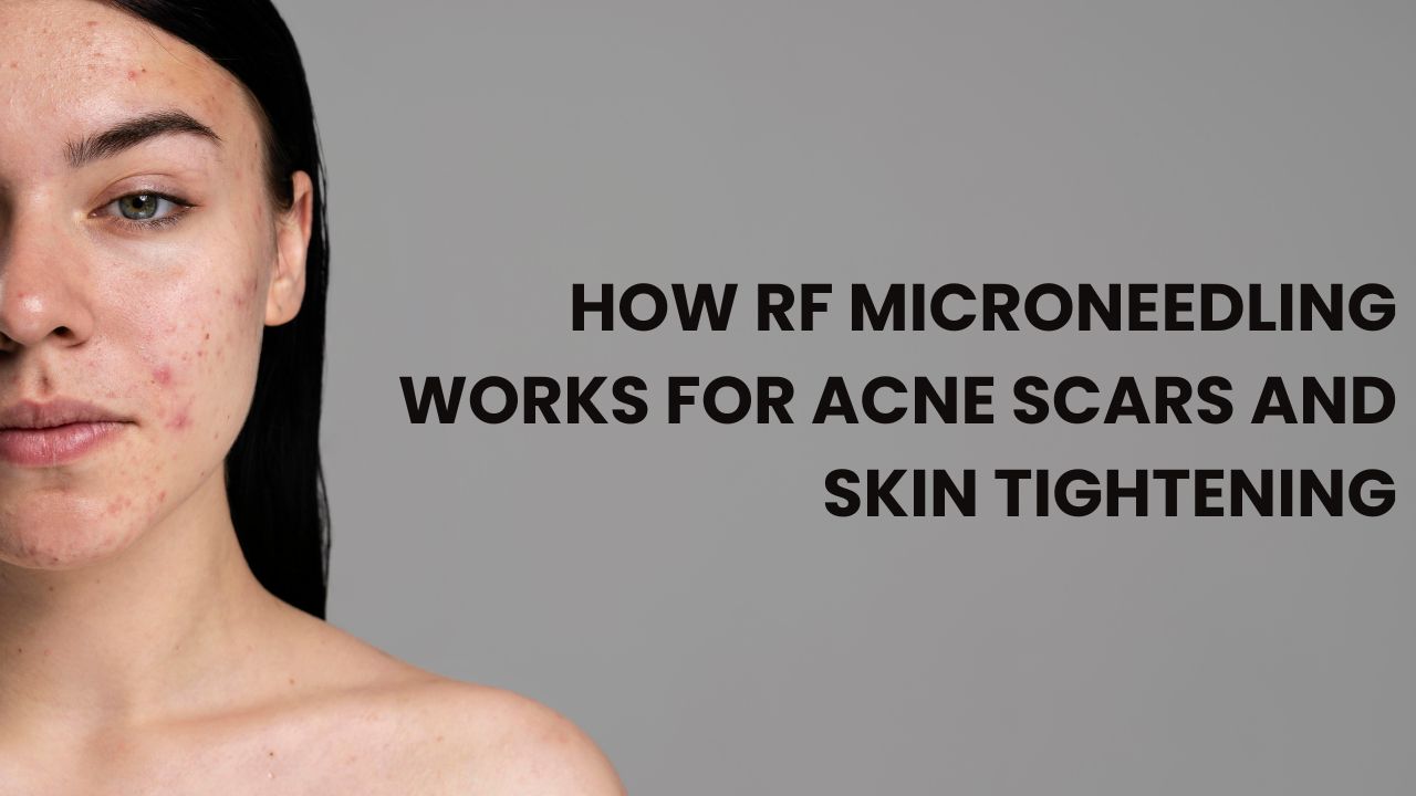 RF Microneedling Works