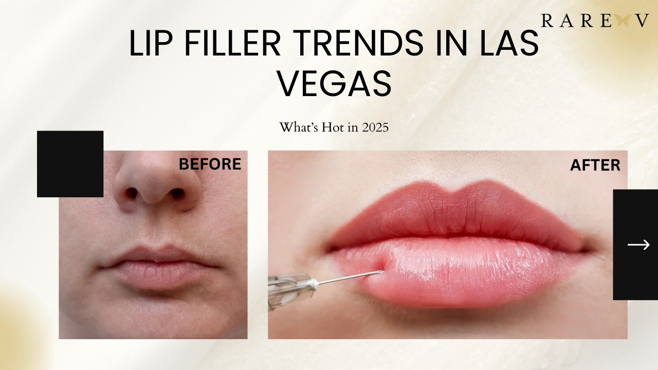 Lip Filler Trends